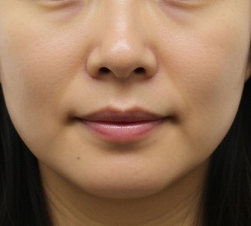 术后