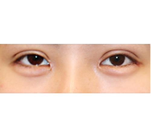 术后
