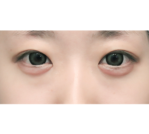 术后