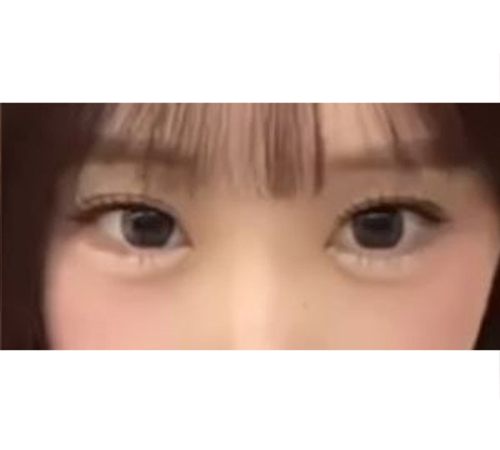 术后