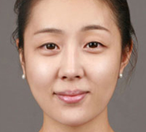 术后
