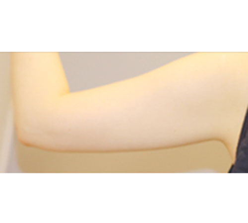 术后