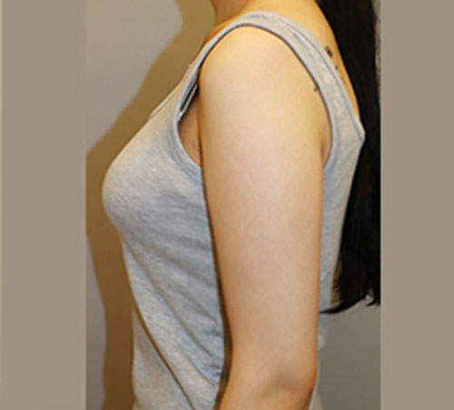 术后