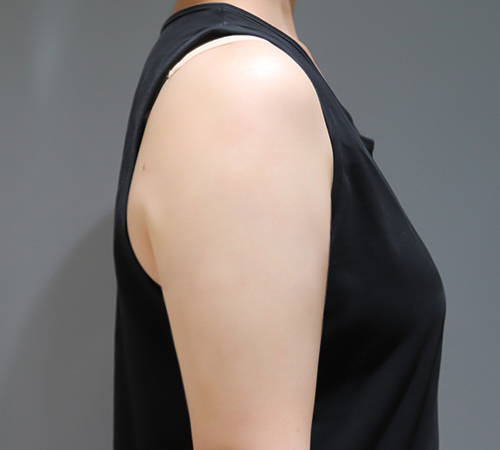 术后