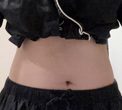 术后