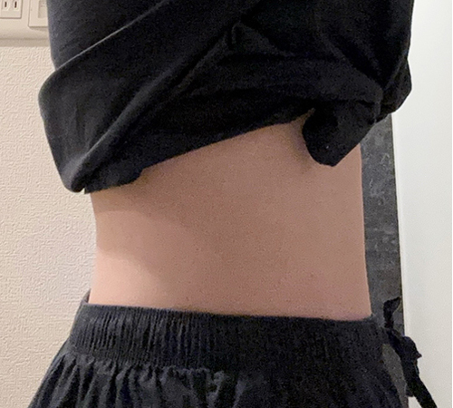 术后