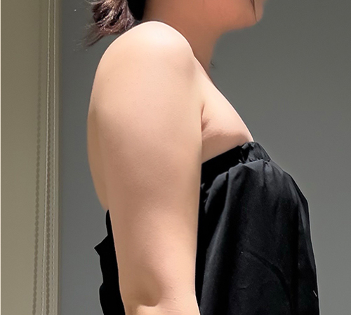 术后