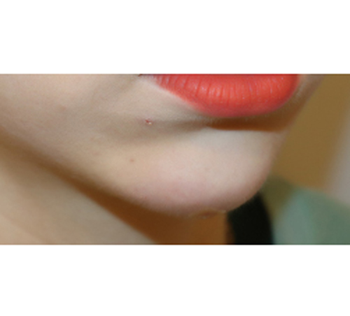术后