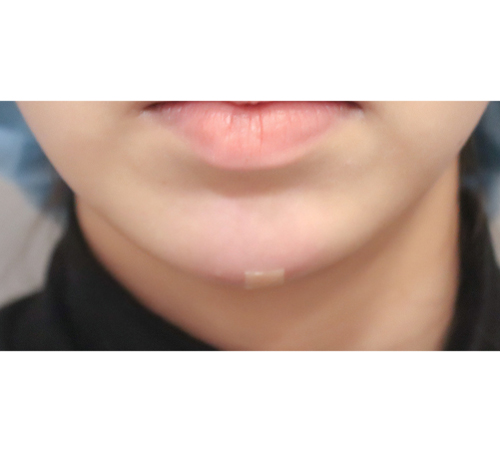 术后