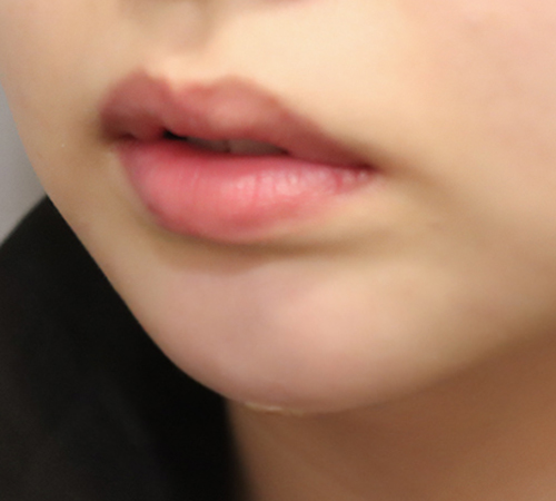术后