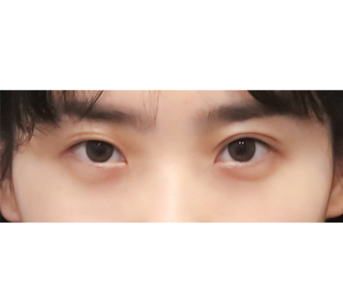术后
