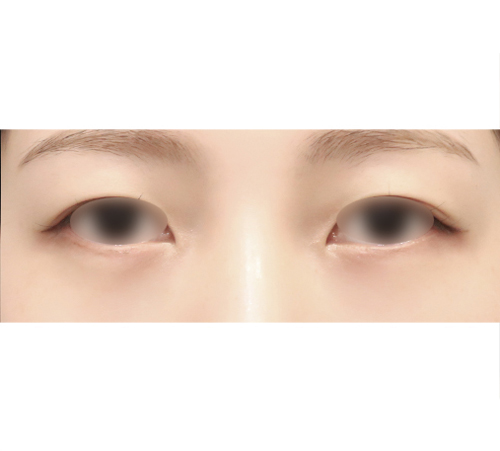 术后