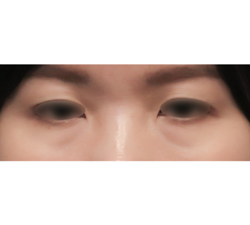 术前