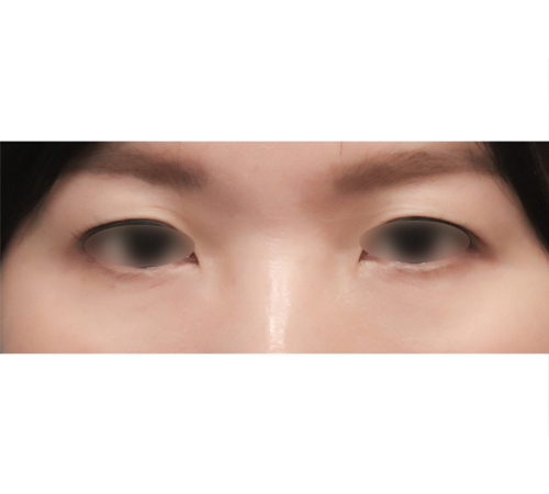 术后