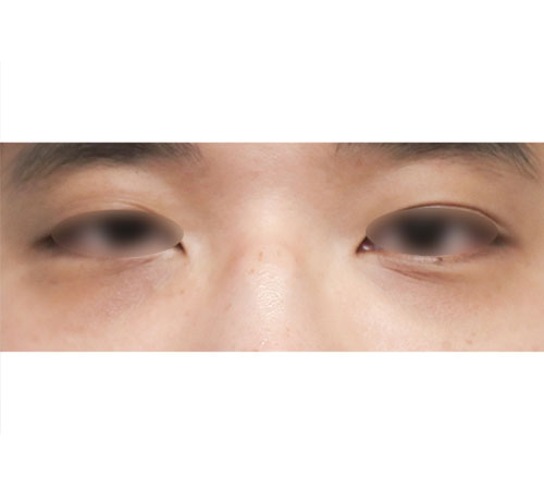 术前