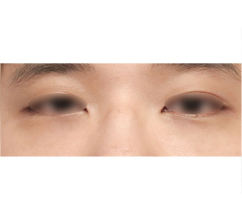 术后