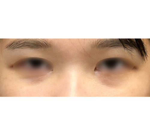 术前