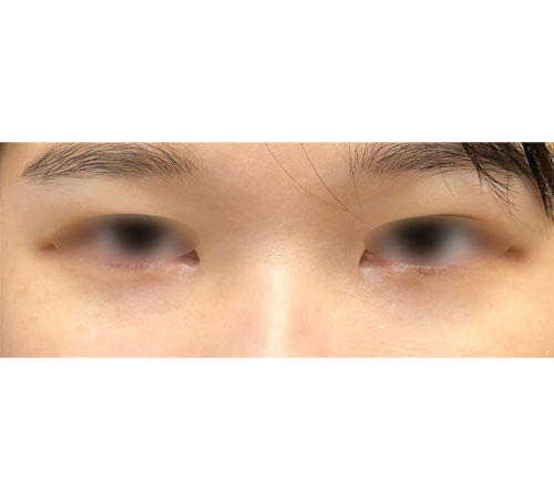 术后