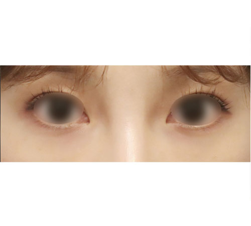 术后
