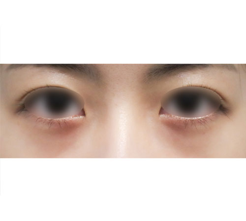 术前