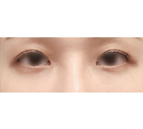 术后