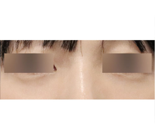 术后