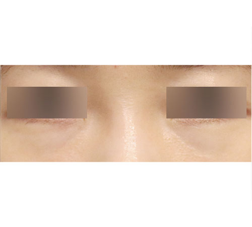 术后