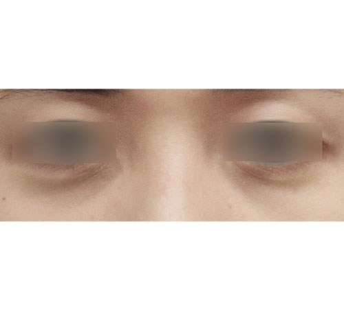 术前