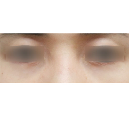 术后