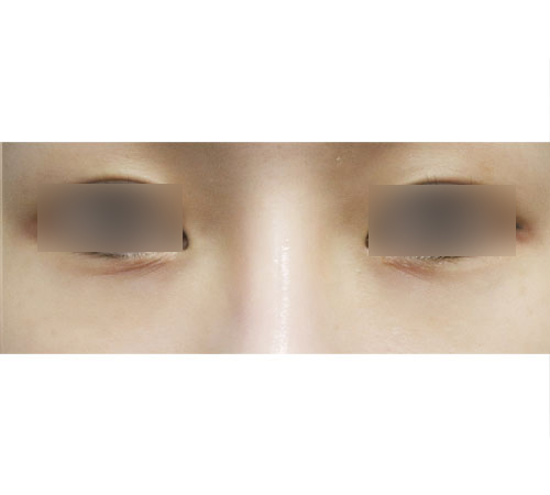 术后