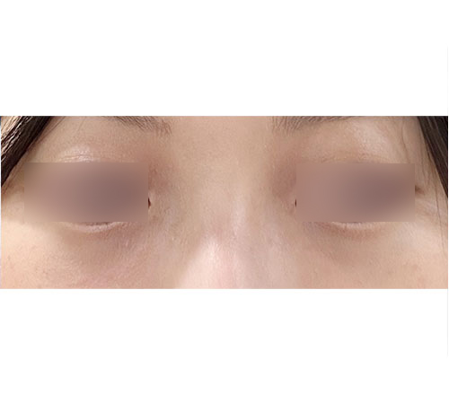 术后