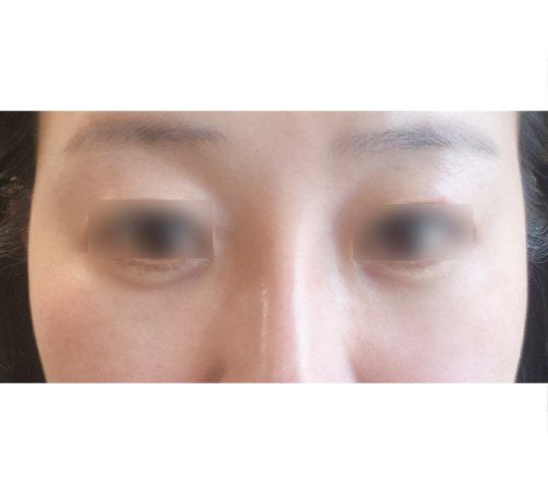术后
