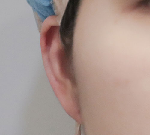 术后