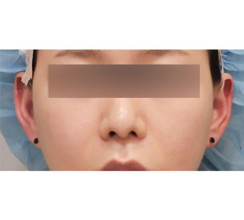 术后