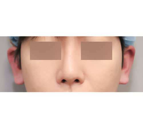 术后