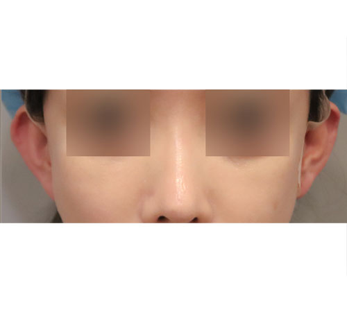 术后