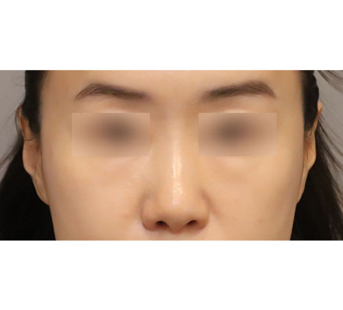 术前
