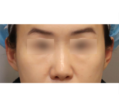 术后