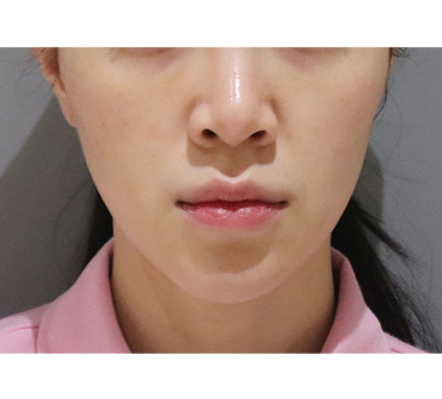 术后