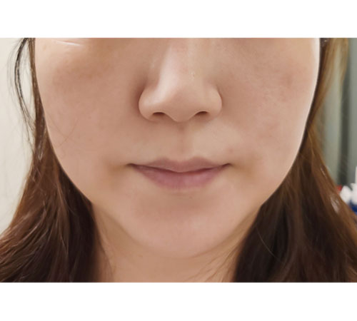 术后
