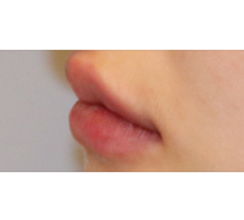 术后