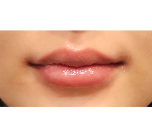 术后