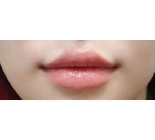 术后
