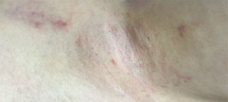 시술 경과 1일차 이미지