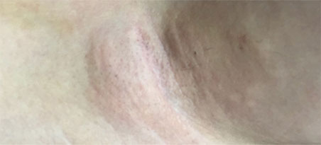 시술 경과 2일차 이미지