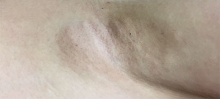 시술 경과 1주차 이미지