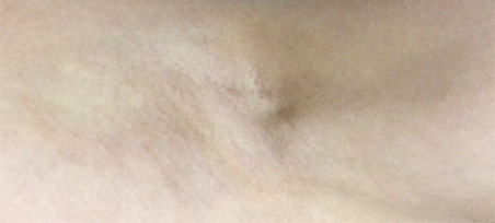 시술 경과 1개월차 이미지