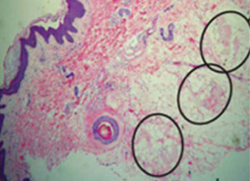 시술 10일 후 조직 이미지