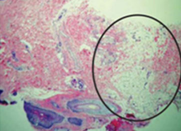 시술 6개월 후 조직 이미지