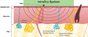 miraDry system 1